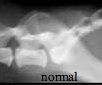 Collapsed lumbosacral intervertebral space

Cauda Equina Compression syndrome
  (2. sclerotic endplates, 3. LS spondylosis deformans)