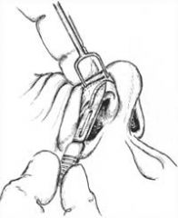 Intercartilaginous AND marginal (image) incisions are made
Allows for increased exposure of the the nasal tip.

Bilateral intercartilaginous incisions are connected in the midline over the anterior septal angle, and the incision extends anterio...