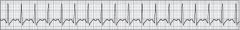 A 70-year-old woman was suddenly awakened with the feeling that she was suffocating. She is anxious, is laboring to breathe, and has dried blood on her lips. The ECG shows the cardiac rhythm below. Which of the following pathophysiologies BEST exp...