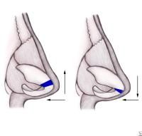 Nasal tip isbest thought of as a tripod, with the medial crura of the lower lateral cartilages constituting one limb, and the lateral crura constituting the other two limbs. 

Tip rotation can be accomplished by lengthening or shortening whichev...
