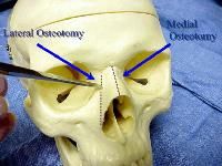 Between the upper lateral cartilages and the nasal septum, and continued through the nasal bones, curving slightly laterally.