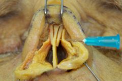 Placement of spreader grafts between the upper lateral cartilages and the cartilaginous septum