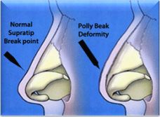 Pollybeak deformity - the supratip projects beyound the tip

Inadequate resection of the supratip dorsum
Failure to reestablish major tip support mechanisms with subsequent loss of nasal tip projection overtime
Scarring in the supratip