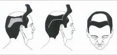 Juri flap is a pedicles temporoparietal-occipital transposition flap based upon the superficial temporal vessels. 
It can be used bilaterally to cover frontal baldness, and modifications involving delaying the flap have resulted in covering large...
