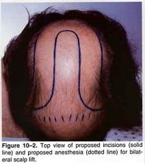 Extensive skin elevation below the nuchal line results in the ability to excise a large area of bald skin