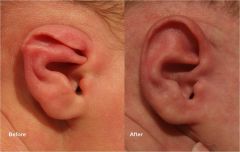 Thin flat ear that is folded down at the superior pole