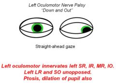 A1. Test pupillary reactions (constriction) by shining light in eye; 
if abnormal, test near reaction
- Absence of pupillary constriction

A2. Test pupillary size/shape
- Anisocoria (unequal pupils); 
Horner's syndrome, CN III paralysis
