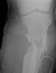 clinical photo and radiograph are consistent with a Grade III open tibia fracture. The referenced study by the LEAP group reviews 527 patients with severe lower extremity fractures and found that the most important factor in determining the abilit...