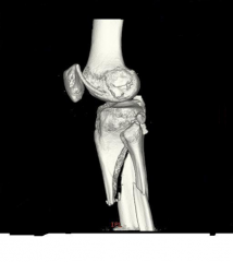 characteristically is malreduced into valgus and apex ant (procurvatum) deformity, techniques to avoid these deformities are: provisional reduc w/ unicortical plates/clamps, semi-extended nailing, suprapatellar nailing, a more lat starting point, ...