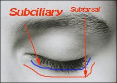 Intraoral approach (mc is canine fossa incision)

subciliary approach