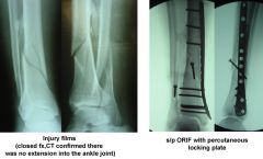 Percutan placement of a lat prox tibial locking plate that extends down to the distl 1/3 of the leg is assoc w/ postop decr sensation of which of the following distributions? 1-Medial hindfoot; 2-Lat hindfoot; 3- First dorsal webspace; 4-Dorsal mi...