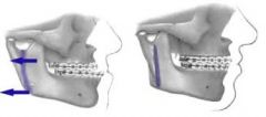 Vertical-ramus osteotomy - involves bilateral osteotomies from the sigmoid notch to the angle of the mandible, posterior to the inferior alveolar nerve bundle. 
The proximal segments are reflected laterally, allowing the anterior mandible (distal...