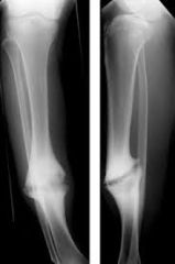 Which of the following types of nonunions is most likely to achieve union following a reamed exchange 
IM nailing only? 1-Dist fem nonunion w/ <10% bone loss; 2-Infected nonunion of the fem shaft; 3-Mid-diaphyseal humeral nonunion w/ <10% bone lo...