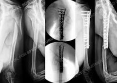 Reamed exchange intramedullary nailing of diaphyseal tibial shaft fractures in which there is <30% of cortical bone loss can achieve union rates ranging between 76%-96%, Humerus nonunions, both diaphyseal and proximal locations, more readily achie...