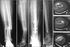 tibial malrotation p/ reamed IM nail fixation as measured by CT. Malrotation = IR/ER deformity > 10 deg. (22%) of the tibia were malrotated > 10 deg and  distal 1/3 fx.