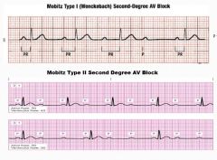 1st degree = P-R > .2s (one big box)
2nd degree = P-R > .2s and not every P results in QRS
       Morbitz type 1: P-R progressively prolonged until QRS drop
       Morbitz type 2: multiple P for every QRS
3rd degree = no association of P with QRS