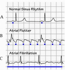 atrial flutter = sawtooth

atrial fibrillation P waves too fast to see