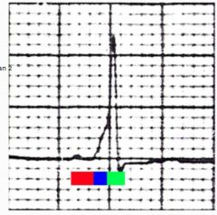 Direct conduction from atria to ventricle via accessory fibre.  Clinical = tachycardia / syncope

ECG: Short P-R, wide QRS (wider than 2 boxes), delta wave (before the R)