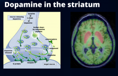 Een verhoogde dopamineaanmaak in het striatum