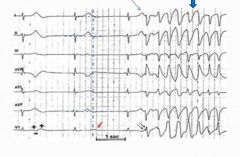 Long QT syndrome, caused by medications (antiarrhythmics, tricyclics, erythromycin)

Genetic (familial long QT syndrome)

Has a longer relative refractory period, which could allow for a ventricular stimulated Q during the T and push the ventr...