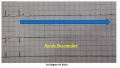 Determine if primary or secondary

If secondary, correct underlying cause.  If primary, pacemaker may be needed, and is the general treatment for chronic bradycardia