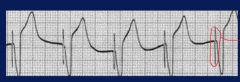 Depolarizes from right ventricle base, then up septum

Has a wide QRS, pacer spike = tell tale sign

Antitachycardia pacemaker capable of either capturing rhythm by speeding up then slowing back down.  Or can cardiovert with a shock to normal ...