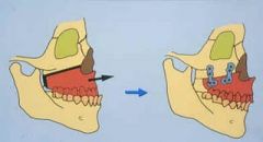 A gingivobuccal sulcus incision from one second molar to the other is performed, and the mucoperiosteum elevated to the pyriform apertures. 
The osteotomy is performed, and the maxilla downfractured for complete mobilization. 
The maxilla can th...