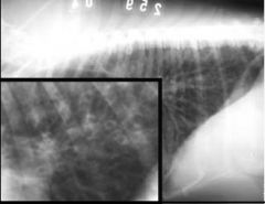 Which lung pattern can be seen?