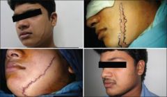 Geometric broken line closure (GBLC) - involves outlining one side of the scar to be excised with an irregular composite of rectangular, triangular and semicircular shapes, and creating a complimentary template for interdigitation on the other sid...