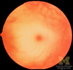 Cherry-red macula. There is a cherry red spot seen on fundoscopic exam - prominent red macular fovea centralis stands out compared to pale retina. This can also be seen in Sandhoffs, Gauchers, and Niemman Pick