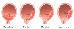 placenta covers internal os

sudden-onset of vaginal bleeding

painless

hx of trauma, coitus, or pelvic exam

NEVER do digital or speculum exam