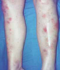 Name the skin condition and the polyarticular disease(s) associated with it