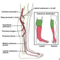 post-op superficial peroneal nerve (SPN) palsy p/ ORIF of a tibial fx using both ex-fix and minimally invasive plate osteosynthesis (MIPO). The less invasive stabilization system (LISS) is a system which utlizes the MIPO technique. This minimally ...