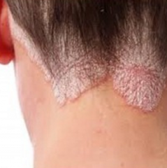 Name the skin condition and the polyarticular disease(s) associated with it