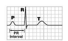La mesure se fait du début de l'onde P au début du QRS. Valeur normale: 0,12 =< PR < 0,20.