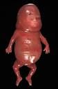 - deletion of all 4 alpha hemoglobin alleles.


- incompatible with life. infants are delivered prematurely and are pale, hydropic, severely anemia and have splenomegaly


- this is also known as hemoglobin bart 