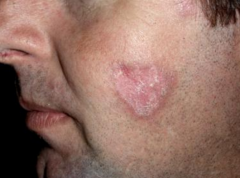Name the skin condition and the polyarticular disease(s) associated with it