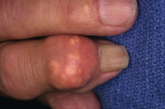 Name the skin condition and the polyarticular disease(s) associated with it
