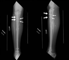 Which of the following techniques does not help prevent valgus angulation during IM nailing of prox 1/3 tibia fx? 1-Use of a blocking screw lat to midline in the prox segment; 2-Use of a blocking screw lat to midline in the distal segment; 3-Use o...