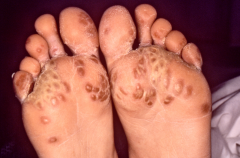 Name the skin condition and the polyarticular disease(s) associated with it