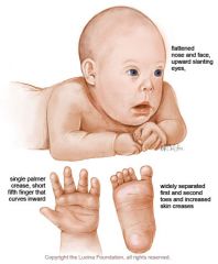 1. Trisomy 21


2. short statue, simian creases, developmental delay with IQs ranging from 40-90. Associated cardiac defects, duodenal atresia or stenosis and short limbs


3. between first trimester screening (PaPP-A, hCG and NT) and 2nd trim...