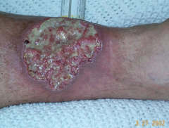 Name the skin condition and the polyarticular disease(s) associated with it