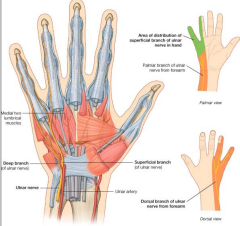 Damage to ulnar nerve. 
• Injury usually occurs at four places: 
1. Posterior to medial epicondyle of humerus (trauma). 
2. Cubital tunnel formed by tendinous arch connecting humeral and ulnar heads of the 
flexor carpi ulnaris (OT Hazard). ...