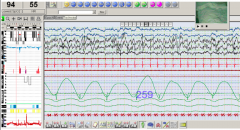 - EEG: recording of the brain's spontaneous electrical activity
- EOG: measuring the resting potential of the retina in the human eye
- EMG: evaluating physiologic properties of muscles
- Respiratory electrodes 

Get full physiologic monitoring.