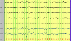 - Central (1, 2) and Occipital (3, 4) EEG leads
- Chin movement (5) - should be no movement during REM
- EOG (eye movements seen in REM) (6, 7)
- EKG (8)