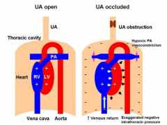 - Increased negative intrathoracic pressure from trying to inhale but no air coming in d/t obstruction
- Increases LV transmural pressure and LV afterload
- Also increases venous return, increasing RV preload
- Hypoxia causes PA vasconstriction...