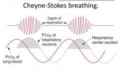 Cheyne-Stokes Breathing
- PCO2 of lung blood goes up and down (sine pattern)
- PCO2 of respiratory neurons slightly behind
- Overshoot and undershoot CO2 levels