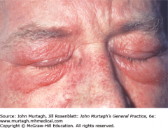weakness + joint and muscle pain + violaceous facial rash 


Dx?
Ix?
Rx?