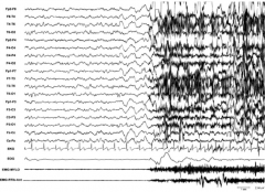 Onset of Night Terror
- Spontaneous attack during stage 3 of NREM sleep
- 2 seconds of diffuse hyper-synchronous high voltage delta wave arousal
- Brief EEG delta discharge immediately preceding the clinical episode
- Increased HR (shown from ...