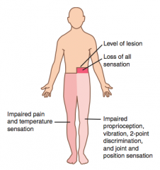 Loss of pain and temperature sensation below level of lesion